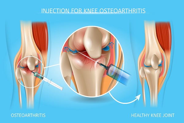 Knee Pain Treatment Ooltewah, TN